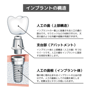 インプラントの構造