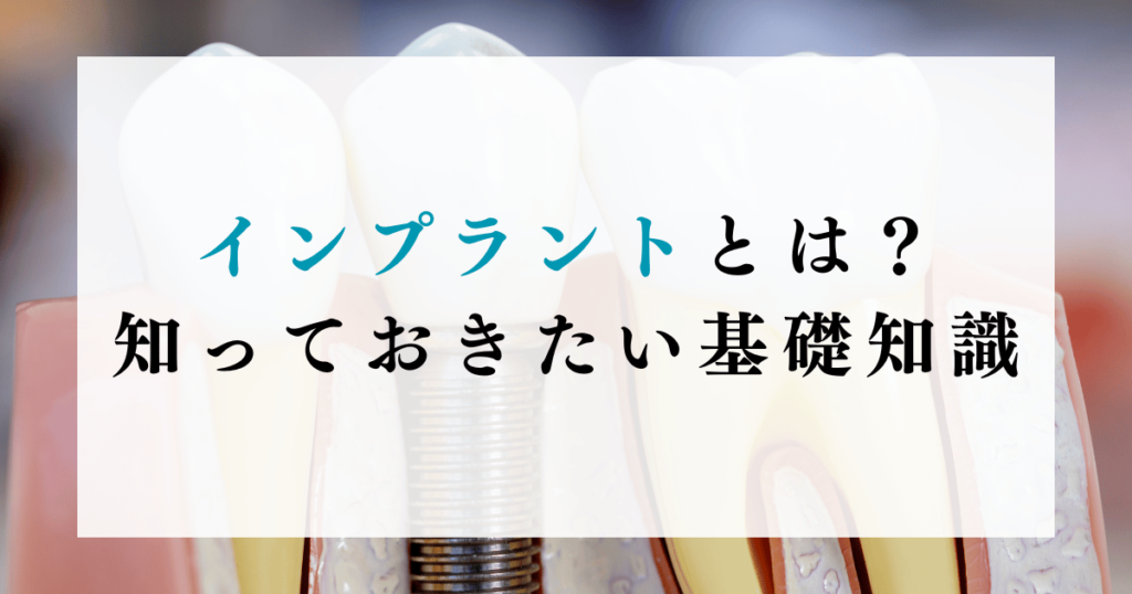 インプラントとは？知っておきたい基礎知識
